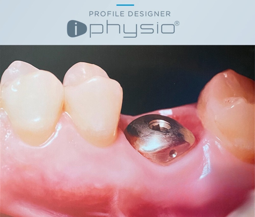 Iphysio - решението, което завинаги улесни имплантирането на зъби